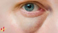 What Is the Fastest Way to Heal a Swollen Eyelid