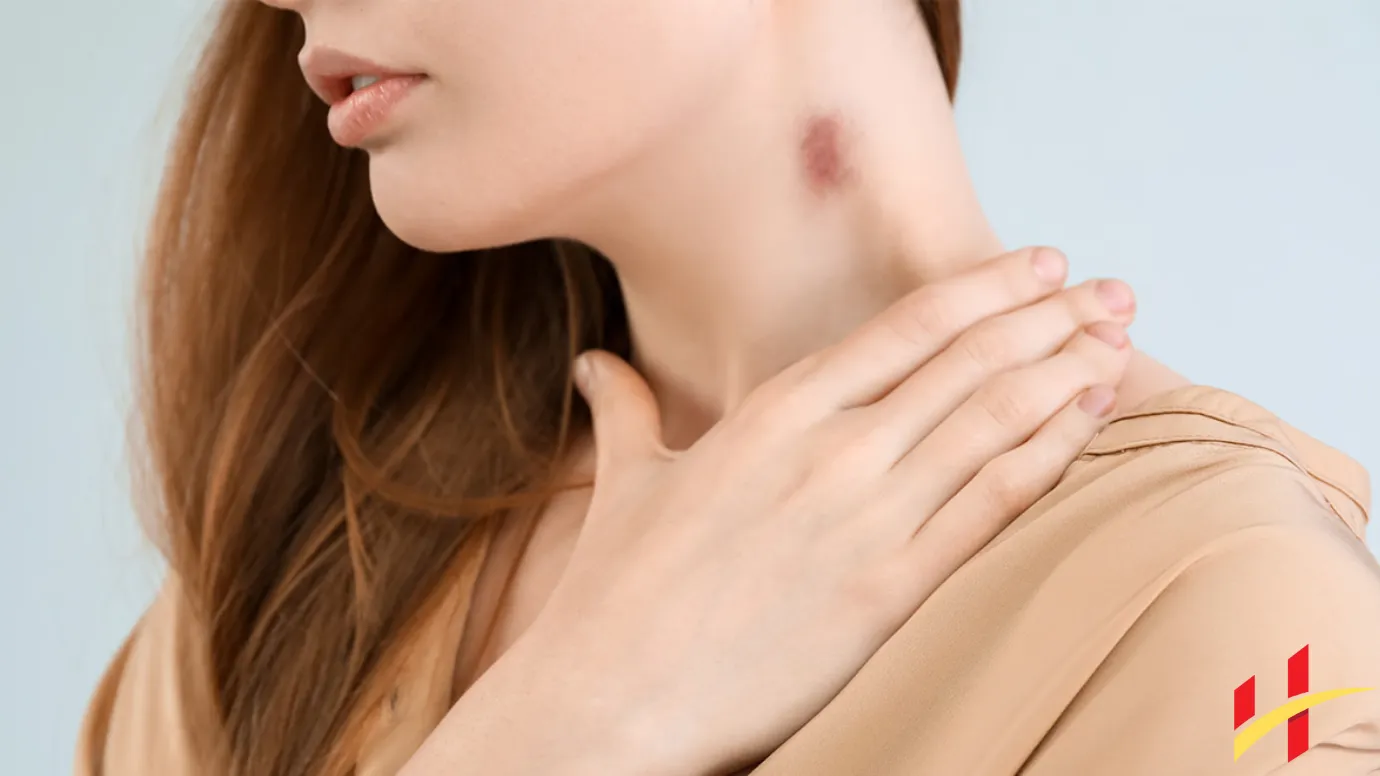 How Long Does It Take for a Hickey to Go Away? Health Fitness Future