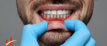 How To Cure Gum Disease