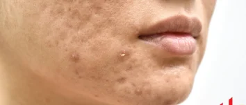 How to Get Rid of Whiteheads