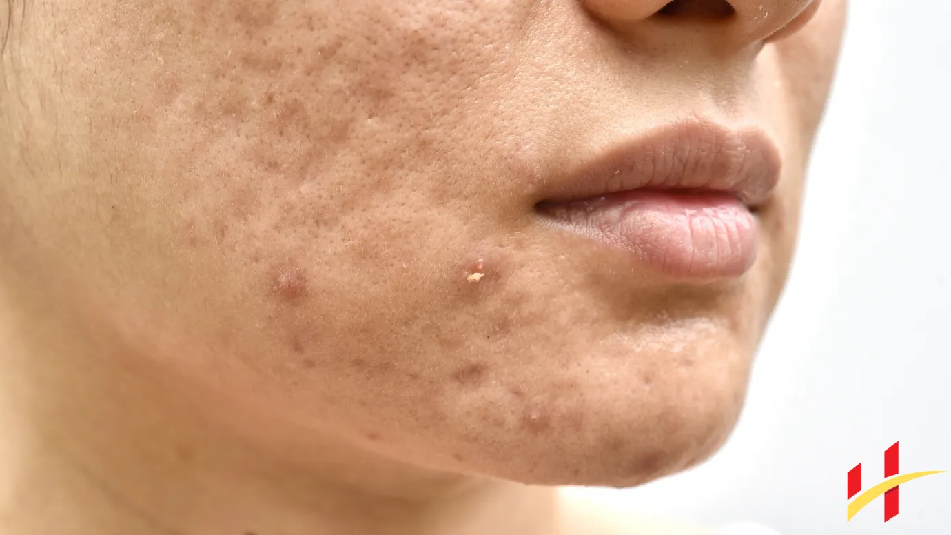 How to Get Rid of Whiteheads