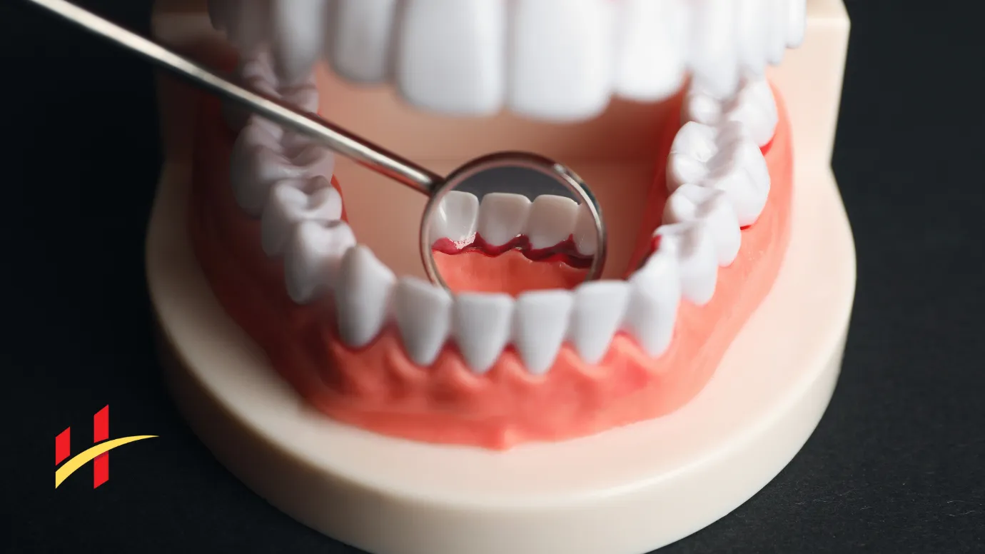 Stages of Gum Disease: