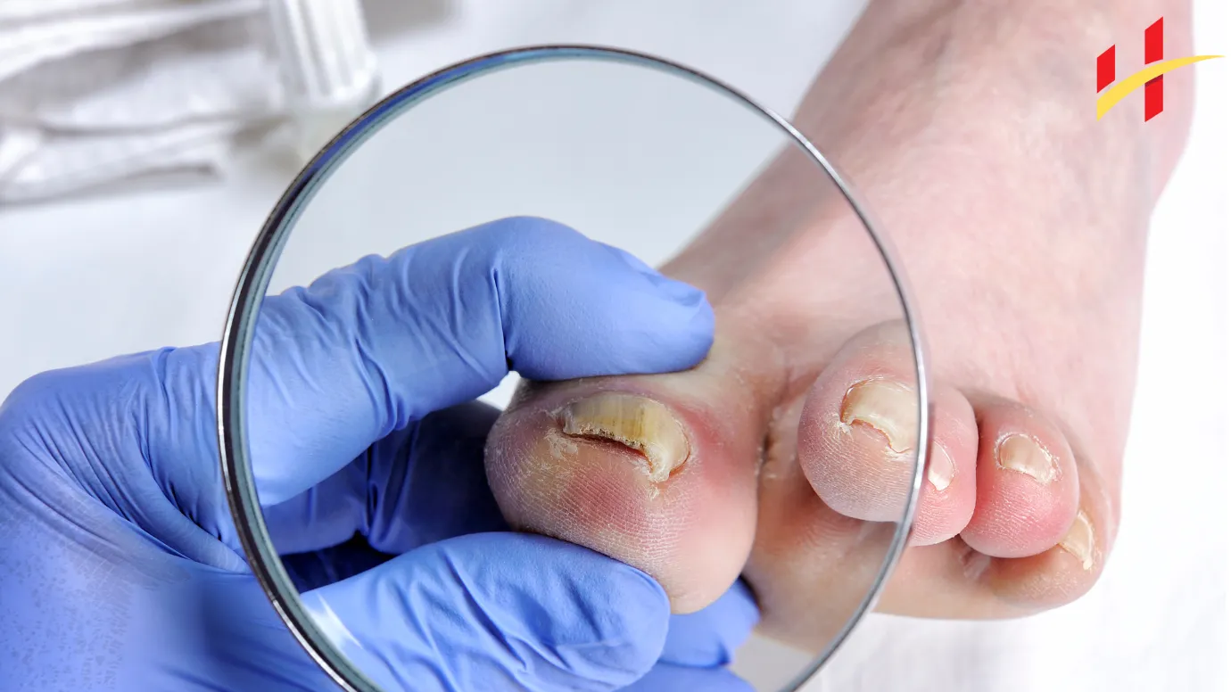 What Kills Toenail Fungus Instantly