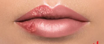Cold Sore Vs Pimple on Lip