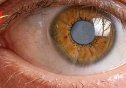 How Long to Wait Between Cataract Surgery on Each Eye