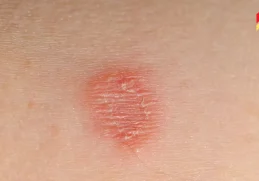 How to Cure Ringworm Fast