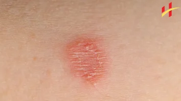 How to Cure Ringworm Fast