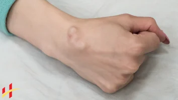How to Drain a Ganglion Cyst Yourself