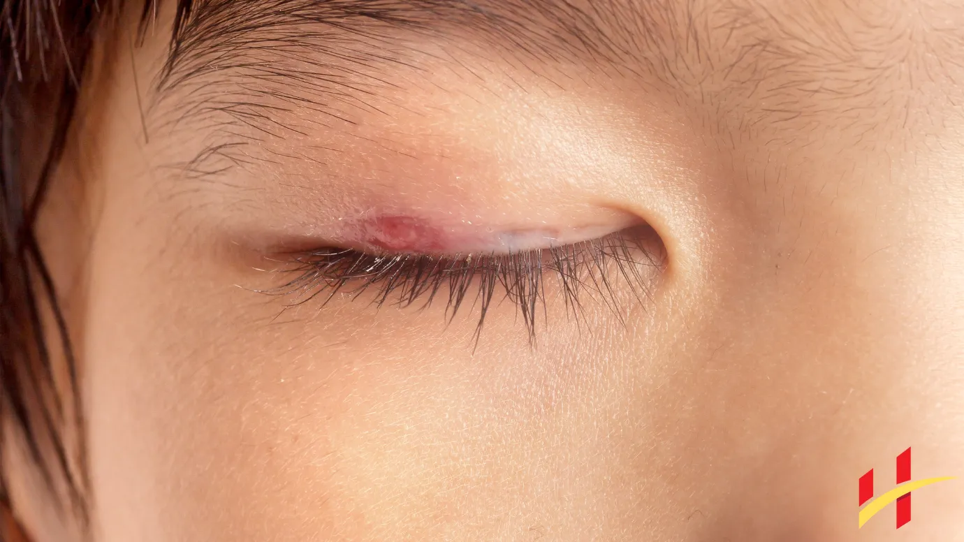 How to Get Rid of a Stye Overnight