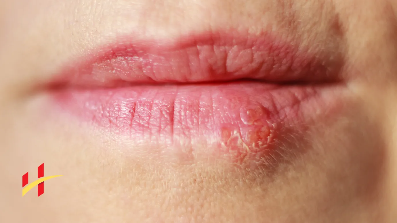 How to Heal Herpes Sores Faster