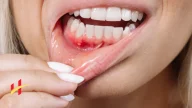 How to Treat Swollen Gums at Home?