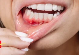 How to Treat Swollen Gums at Home?